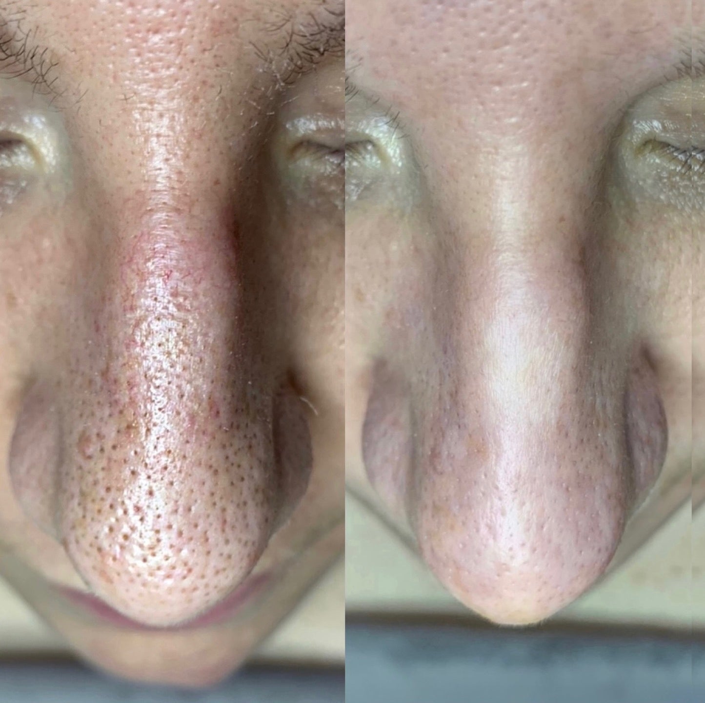 Dr. Melaxin Rice Peel Shot Ampoule™